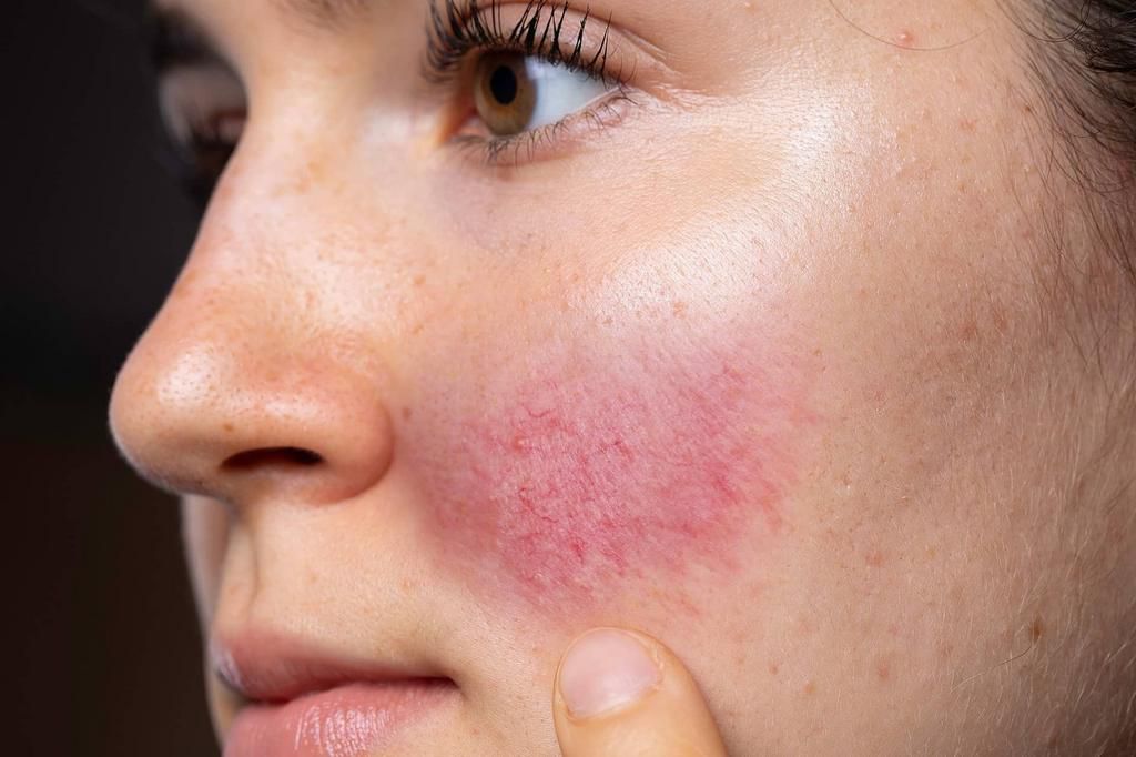 Rosacea