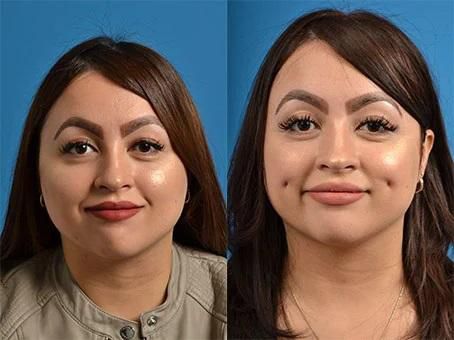 Some people want artificial dimples [Clevensfaceandbodyspecialist]