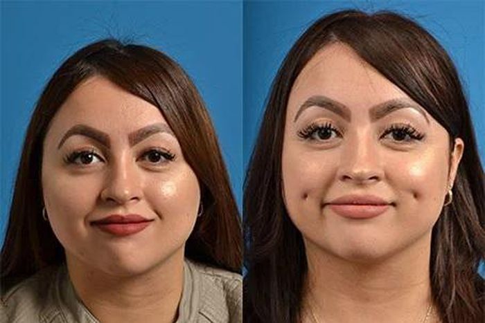 Some people want artificial dimples [Clevensfaceandbodyspecialist]