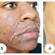 An example of a chemical peel [Healthglow]