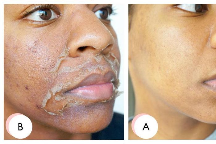 An example of a chemical peel [Healthglow]