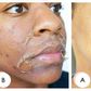 An example of a chemical peel [Healthglow]