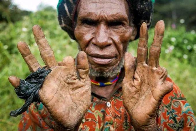 When someone dies, family members cut off their own fingers. [Facebook/Henry Kally Jme]