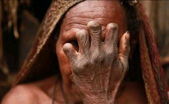 Older women of the Dani tribe with snipped fingers. [Facebook/Henry Kally Jme]