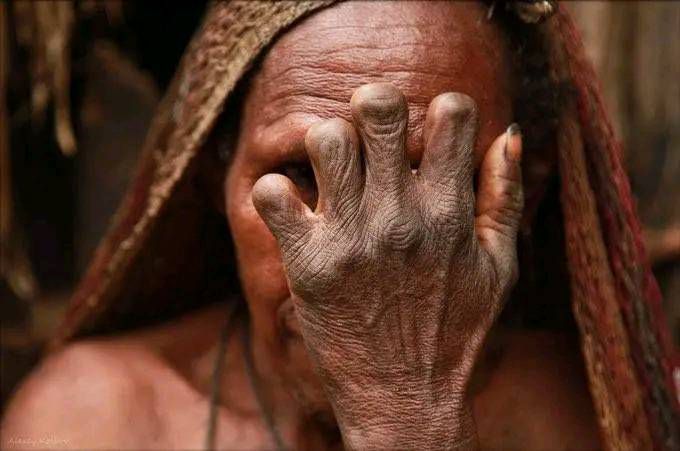 Older women of the Dani tribe with snipped fingers. [Facebook/Henry Kally Jme]