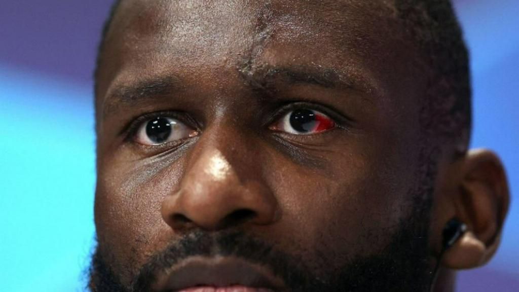 Rudiger shows off red eye, ready for Werner as Real Madrid clash with Leipzig