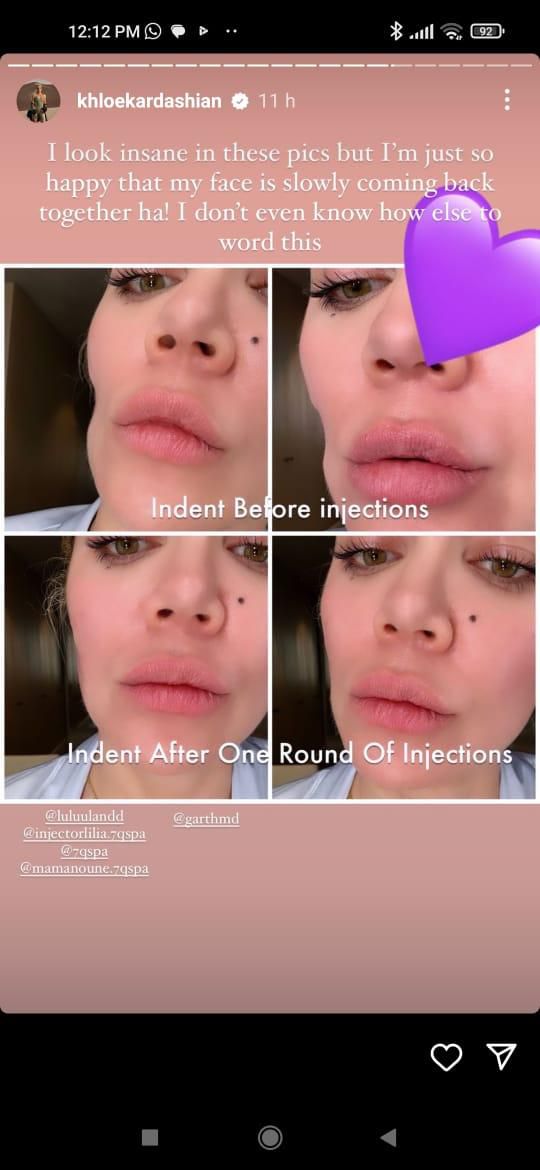 Khloe documents her progress before and having the indentation filled