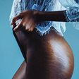 Here's how you can fade your stretch marks [Pinterest]