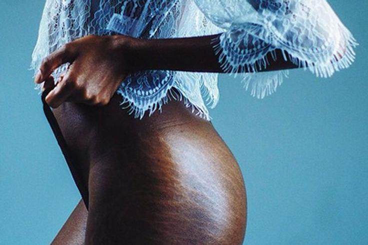 Here's how you can fade your stretch marks [Pinterest]