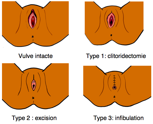 Types of Female Genital Mutilation [GamsBelgique]