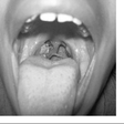 diphtheria (SemanticScholar)