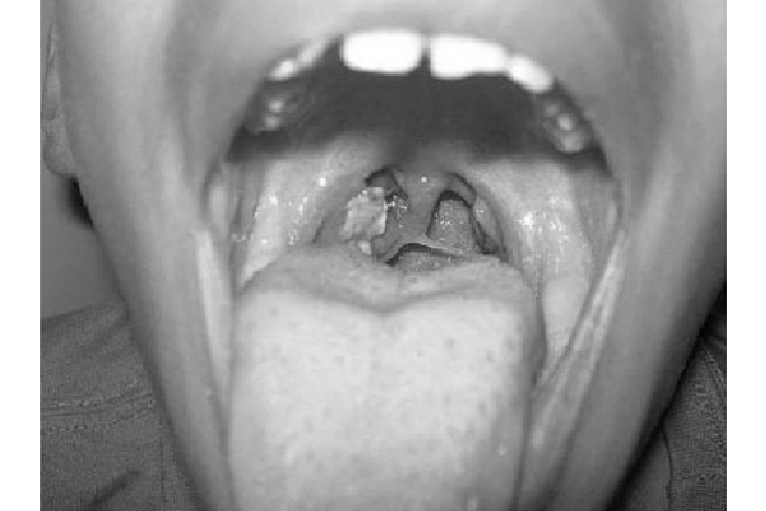 diphtheria (SemanticScholar)