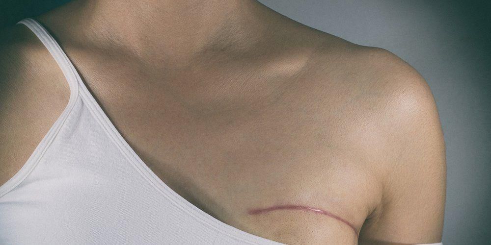 'What Shocked Me Most About Having Breast Cancer'