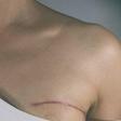 'What Shocked Me Most About Having Breast Cancer'