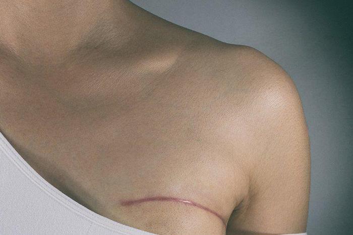 'What Shocked Me Most About Having Breast Cancer'