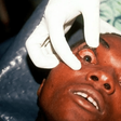 Marburg Virus (Healthnews)