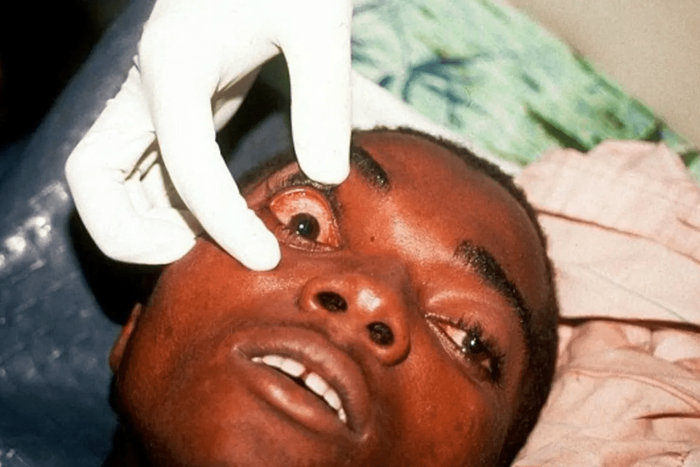 Marburg Virus (Healthnews)