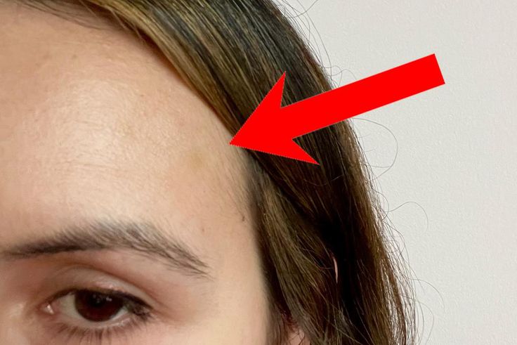 I got a few small bruises on my forehead after my Botox injections. Julia Pugachevsky