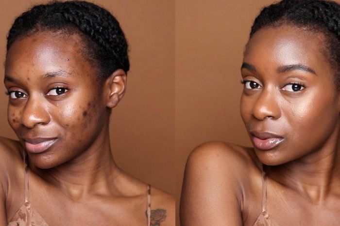 There's an art to concealing pimples [Naakie Nartey]