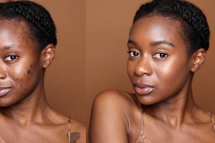 There's an art to concealing pimples [Naakie Nartey]