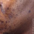 Hyperpigmentation and acne ruins the skin [afpg]