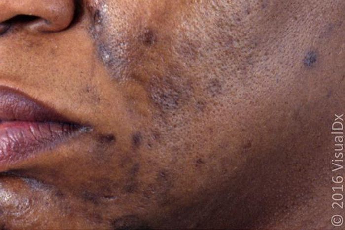 Hyperpigmentation and acne ruins the skin [afpg]