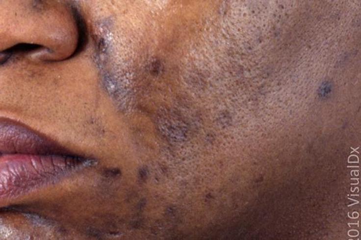 Hyperpigmentation and acne ruins the skin [afpg]