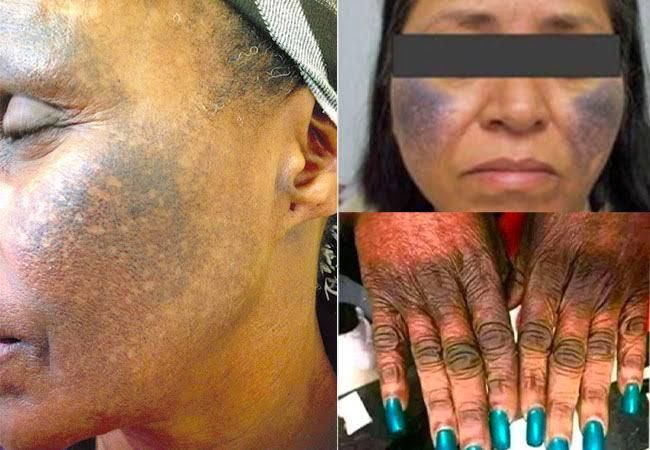 Using bleaching creams can permanently damageyour skin [DailyTrust]