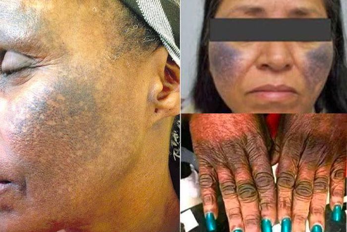 Using bleaching creams can permanently damageyour skin [DailyTrust]