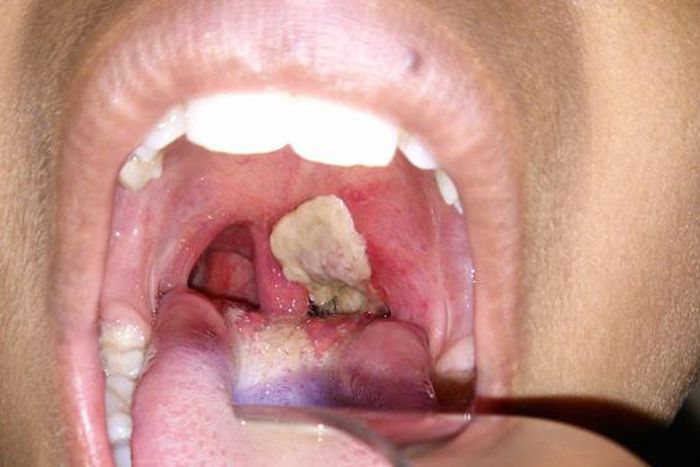 Diphtheria deaths hit 34, Kano registers 100 infections.