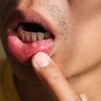 Mouth ulcer