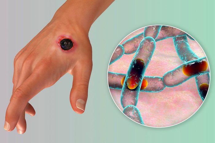 There's an anthrax outbreak in Nigeria. [shutterstock]