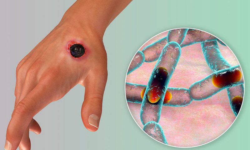 There's an anthrax outbreak in Zamfara State, Nigeria.