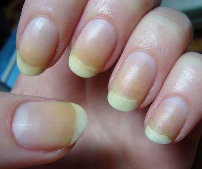 Yellow nails [lesalon]