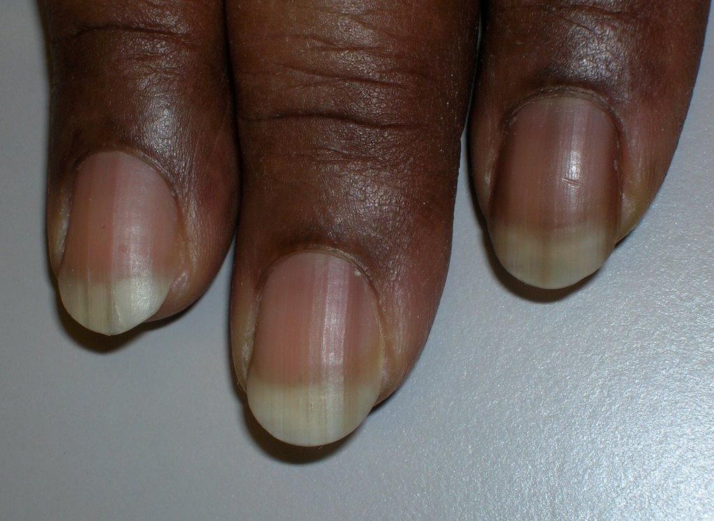 Dark lines in nails [healthline]