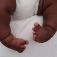 Clubfoot deformity in babies [Daily Monitor]