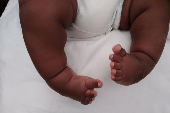 Clubfoot deformity in babies [Daily Monitor]