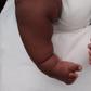 Clubfoot deformity in babies [Daily Monitor]