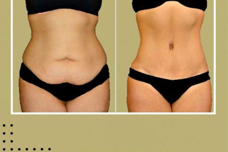 Why does the tummy accumulate fat? [Pinterest]