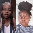 Lady loses one eye after attack by a man whose advances she rejected
