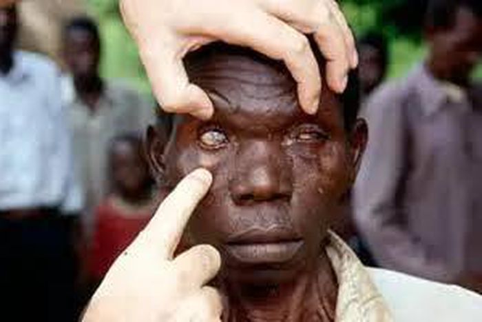 England charity offers lifelines to millions of visually-impaired Nigerians  [Tribune]