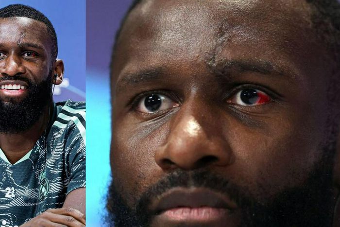Rudiger shows off red eye, ready for Werner as Real Madrid clash with Leipzig