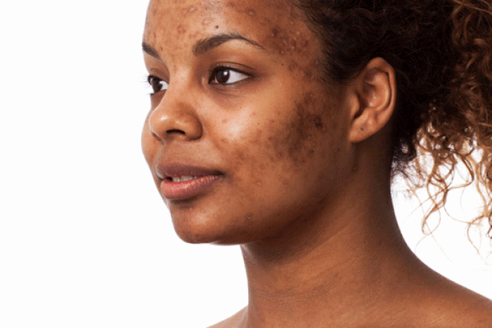 How skincare merchants were exposed for damaging people's skin [aestheticskinblog]