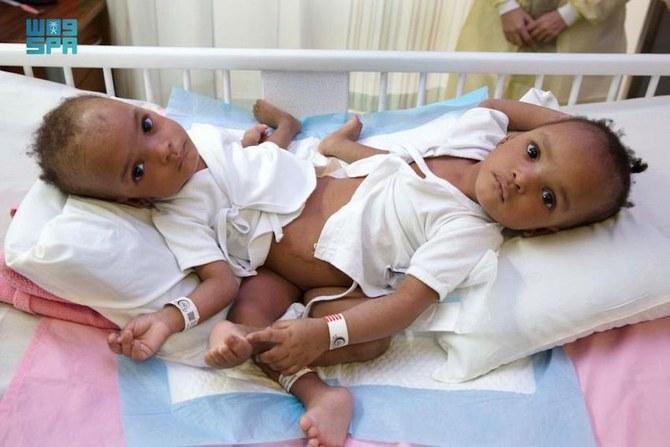 The Nigerian conjoined twins, Hassana and Hussaina are currently in a separation surgery [Arab News]