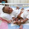 The Nigerian conjoined twins, Hassana and Hussaina are currently in a separation surgery [Arab News]