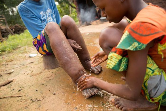 Health Ministry says 122m Nigerians at risk of contracting Neglected Tropical Diseases. [sabin]