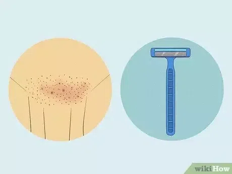 Pimples on pubic area can be caused by shaving [wikiHow]