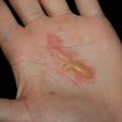 A palm with blisters