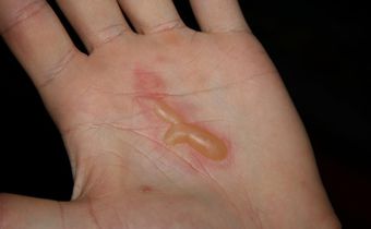 A palm with blisters
