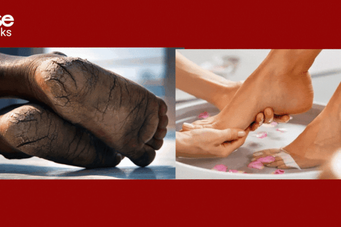 Remedies for cracked feet